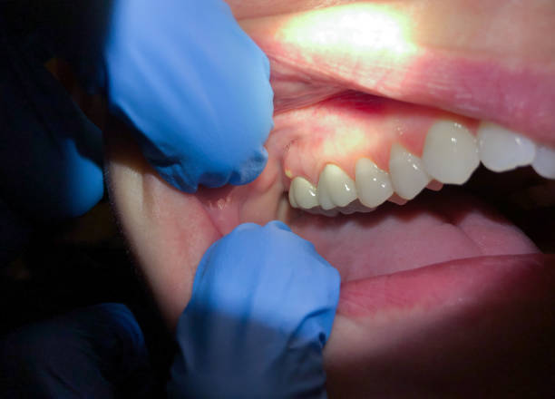 Best Emergency Dentist for Lost Fillings or Crowns in Atoka, TN